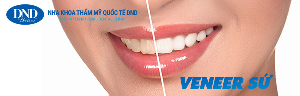 Veneer sứ – Phục hình thẩm mỹ bảo tồn răng thật - Nha khoa Quốc tế DND