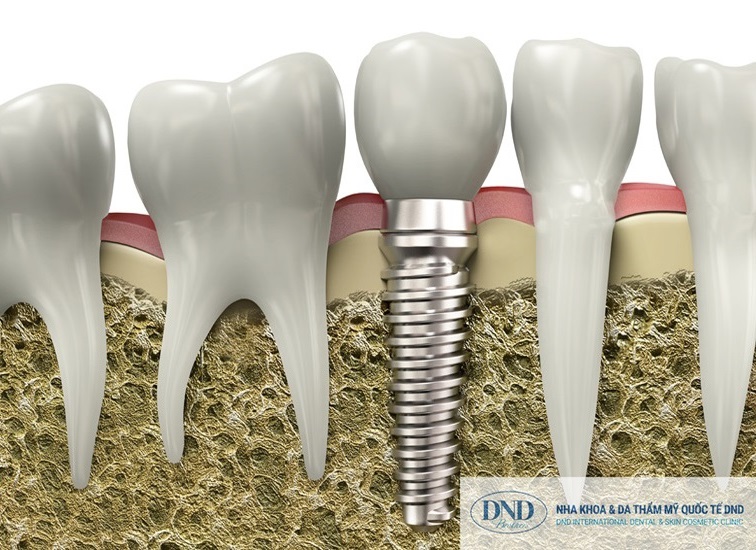 Ghép xương nâng xoang trong Implant - Nha khoa Quốc tế DND