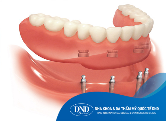 Hàm phủ trên Implant - Nha khoa Quốc tế DND