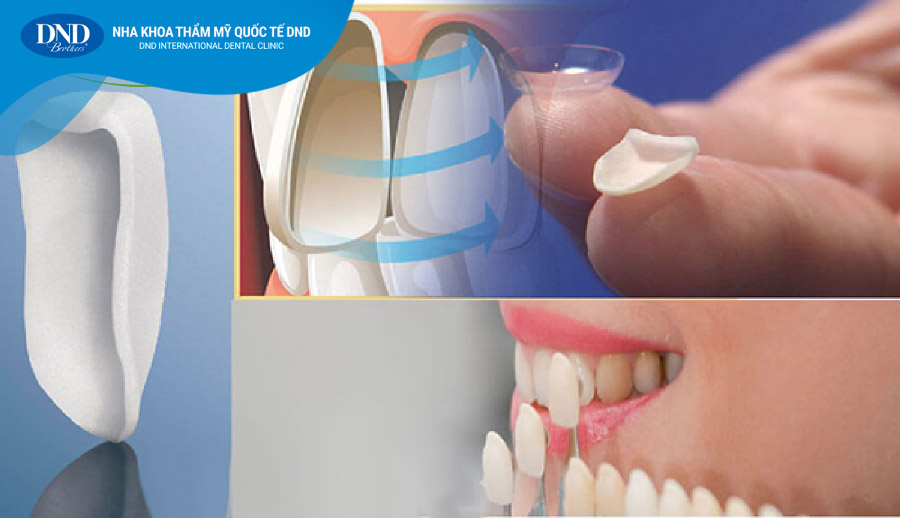Veneer sứ – Phục hình thẩm mỹ bảo tồn răng thật - Nha khoa Quốc tế DND