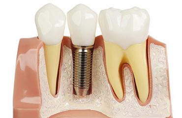 Cấy ghép răng Implant - Nha khoa Quốc tế DND