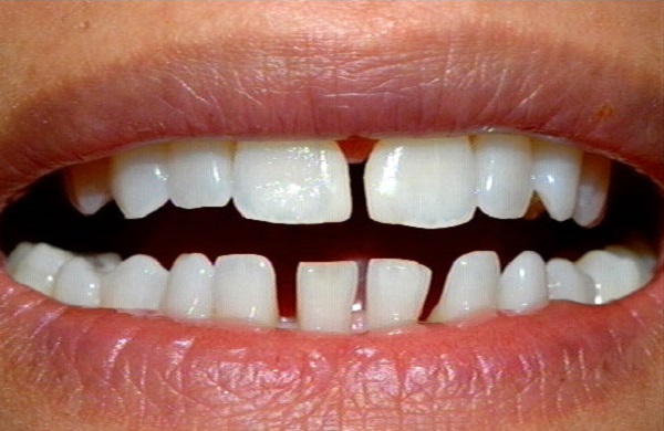 bọc răng sứ mất bao lâu - Ceramic Crown - Nha khoa Quốc tế DND