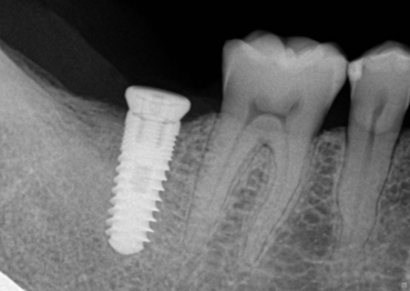 Cấy ghép răng Implant - Nha khoa Quốc tế DND