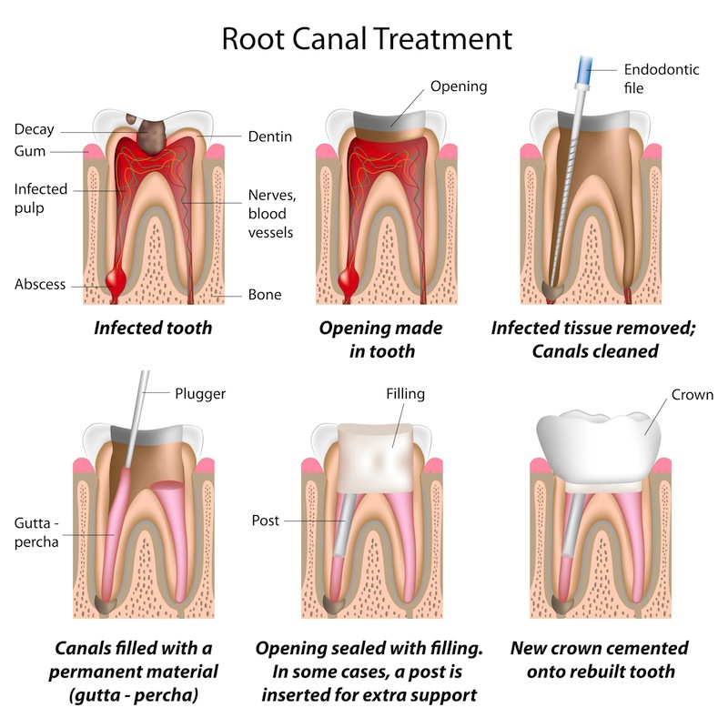 pulp-dental-baby-root-canal