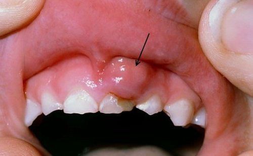 Cao răng tồn tại lâu trong miệng sẽ gây ra nhiều bệnh lý răng miệng ở trẻ em
