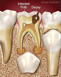 Lỗ sâu tiến vào tủy răng gây nhiễm khuẩn và có thể phá hủy mầm răng vĩnh viễn