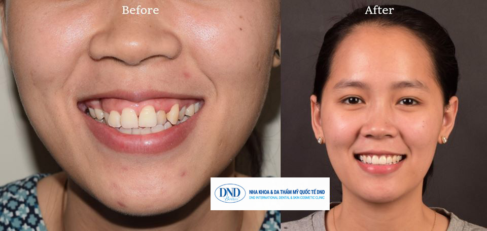 Khách hàng niềng răng Invisalign thành công tại Nha khoa Quốc tế DND