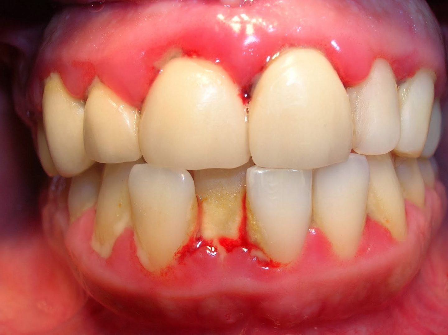 Viêm lợi nếu không chữa trị kịp thời sẽ chuyển sang viêm quanh răng