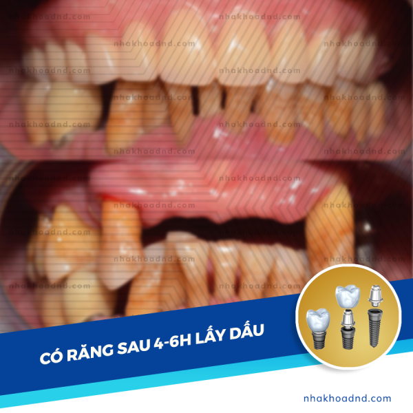 5 thac mac thuong gap khi Cay ghep Implant - Tran Quang Vinh