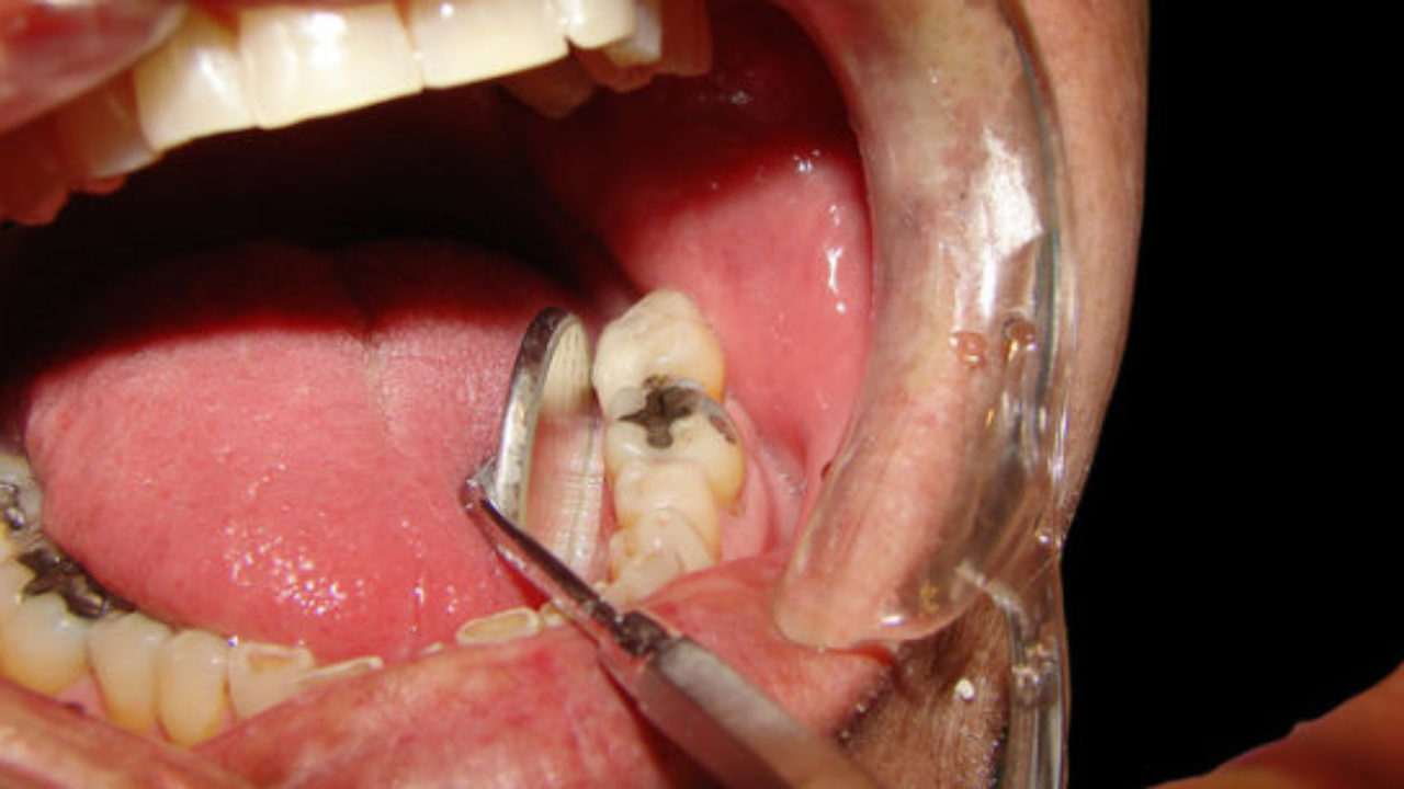 Biến chứng bọc răng sứ nguy hiểm 