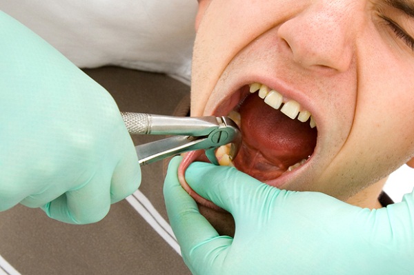 Biến chứng sau nhổ răng