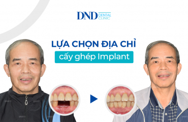 cay-ghep-implant