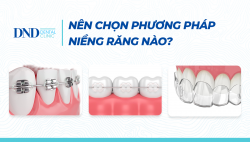 3-phuong-phap-nieng-rang