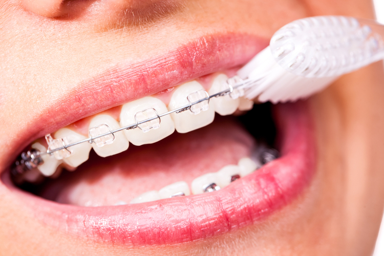 Cần chuẩn bị kỹ càng các sản phẩm để vệ sinh răng miệng sau khi niềng