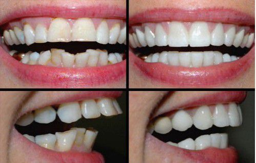 Bọc răng sứ chữa hô giúp bạn có nụ cười tươi tắn, hàm răng đều đẹp trong thời gian ngắn