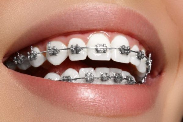 Niềng răng là cách bác sĩ sẽ sử dụng dây cung cùng mắc cài trên bề mặt răng