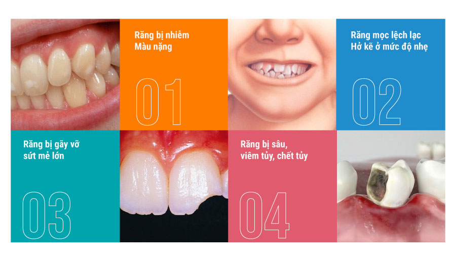 Bọc răng sứ giúp bạn phục hồi lại các khuyết điểm của răng