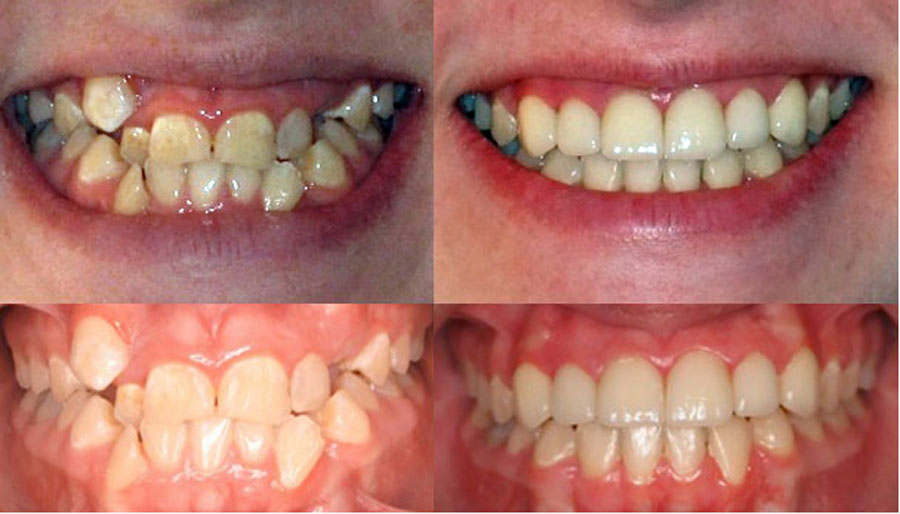 Trường hợp răng mọc lệch lạc nhờ bọc răng sứ mà răng đều đẹp hơn