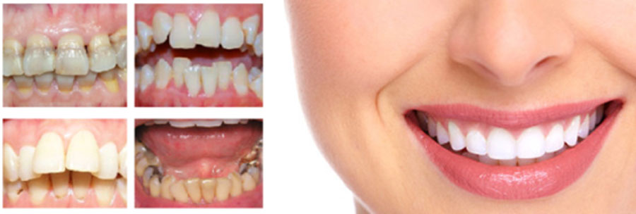 Những trạng thái của răng mà bạn nên bọc răng sứ
