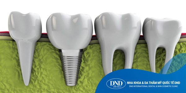 Cấy Ghép Răng Implant - Nha khoa Quốc tế DND