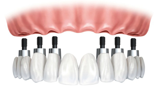 Dịch vụ cấy ghép răng implant all on 4 - Nha khoa Quốc tế DND