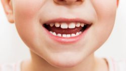 Điều trị sâu răng cho trẻ – Nha Khoa Quốc Tế DND