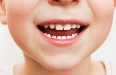 Điều trị sâu răng cho trẻ – Nha Khoa Quốc Tế DND