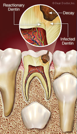 Tủy răng sinh ra ngà phản ứng bảo vệ - Điều trị tủy cho trẻ em - Nha khoa Quốc tế DND