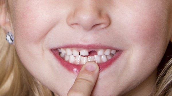 Nhổ răng sữa cho trẻ - Nha khoa Quốc tế DND