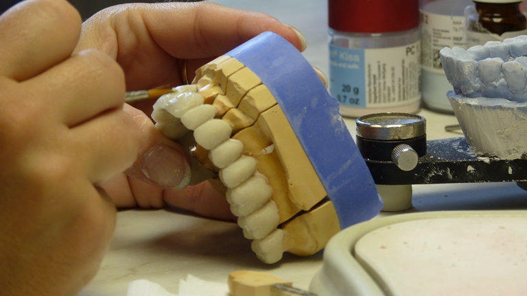 Chế tác răng sứ - Bọc răng sứ thẩm mỹ – Nha Khoa Quốc Tế DND