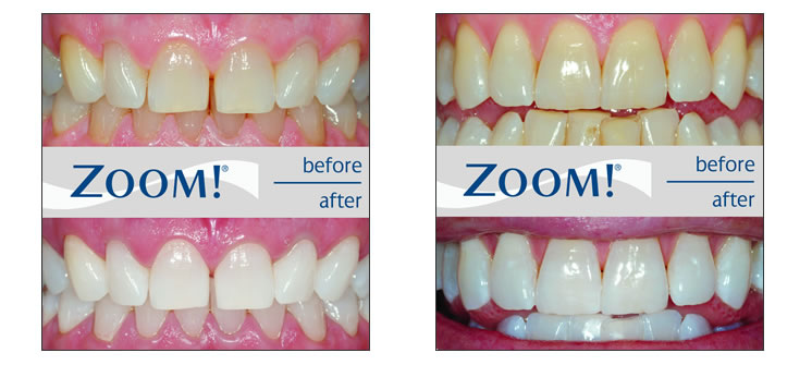 Figure 2: hình ảnh răng trước và sau tẩy trắng với Zoom. Tẩy trắng răng an toàn - Nha khoa Quốc tế DND