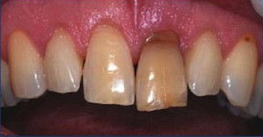 Figure 3: răng đổi màu do hoại tử tủy lâu ngày không được điều trị