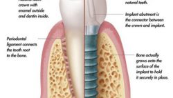 Dental implants - Cấy ghép implant