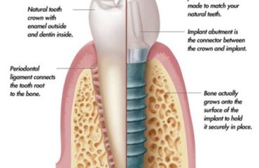 Dental implants – Cấy ghép implant Dental implants - Cấy ghép implant