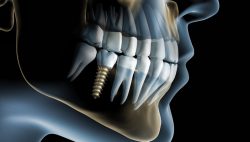 Cấy ghép răng Implant -Nha khoa Quốc tế DND
