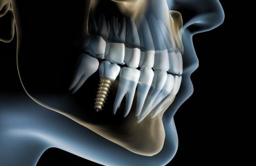 Cấy ghép răng Implant -Nha khoa Quốc tế DND