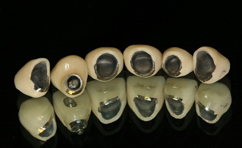 Bọc răng sứ sườn kim loại - nha khoa quốc tế DND