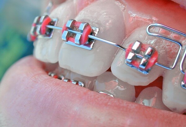 mắc cài tự buộc và mắc cài tiêu chuẩn - self-ligating braces and regular braces - Nha khoa Quốc tế DND