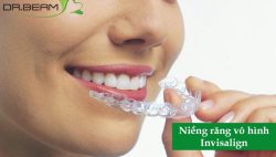 5 lý do chọn niềng răng trong suốt invisalign