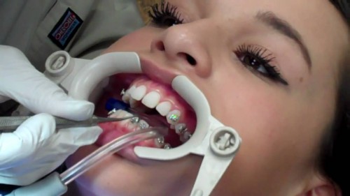quy trình lắp răng sứ