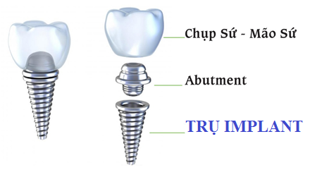 Trụ Implant được cấy vào xương hàm thay thế cho chân răng tự nhiên