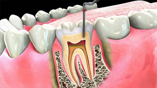 Hiện có nhiều phương pháp điều trị tủy răng cho trẻ em