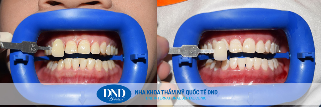 Trước và sau tẩy trắng răng tại Nha khoa Quốc tế DND