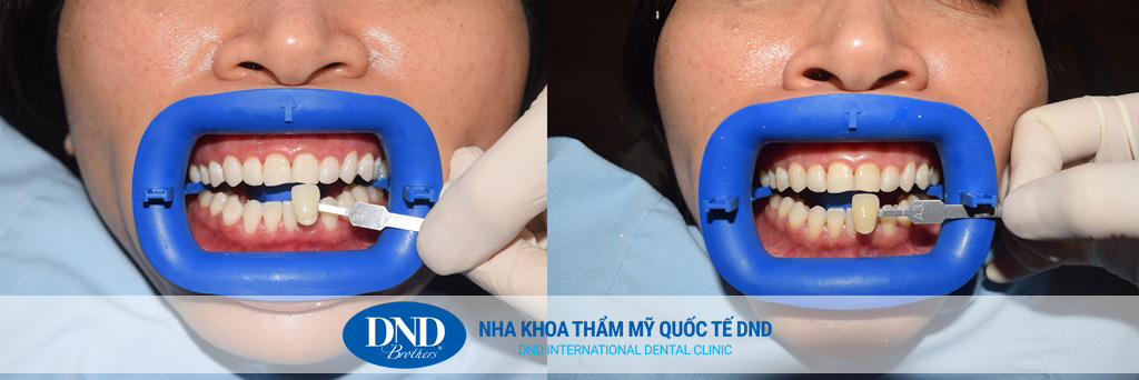 Trước và sau tẩy trắng răng tại Nha khoa Quốc tế DND