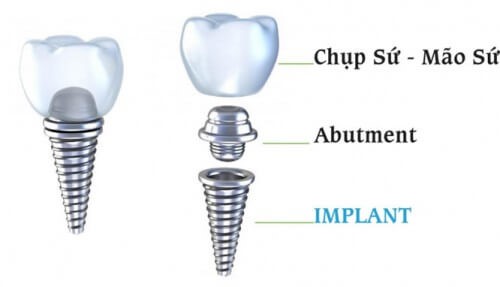 Cấu tạo Implant
