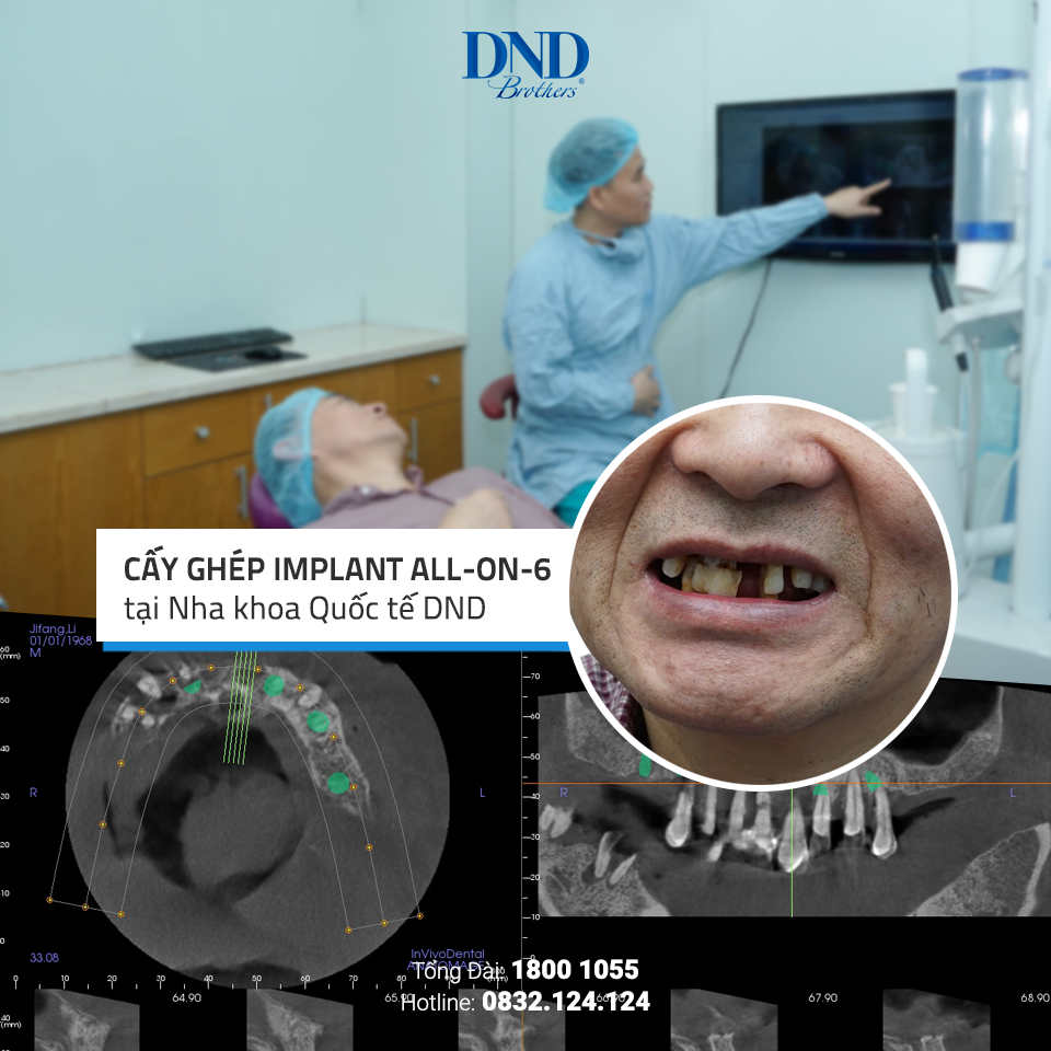 Một ca cấy ghép Implant tại Nha khoa Quốc tế DND