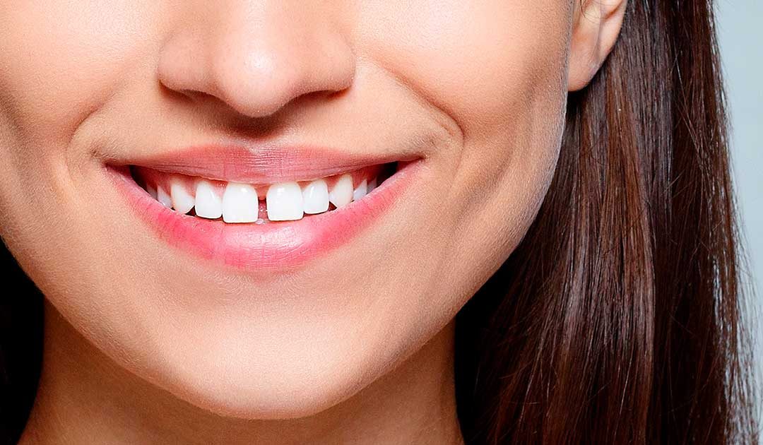 Làm gì để khắc phục răng thưa?