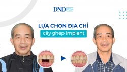 cay-ghep-implant