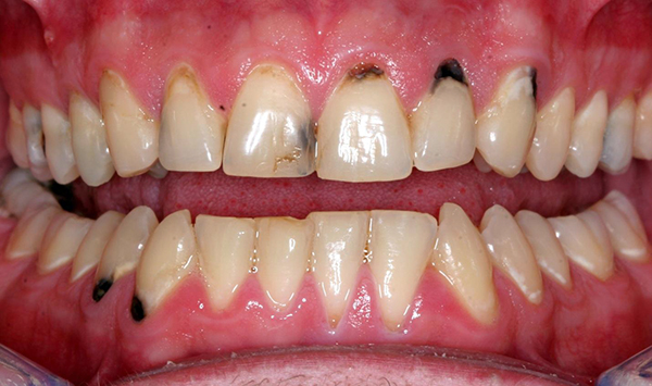 Răng đã bị lấy tủy sẽ có hiện tượng cứng khớp làm cho việc niềng răng gặp nhiều trở ngại