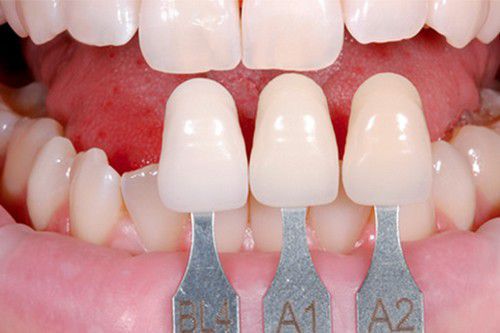 Miếng dán sứ sẽ được chế tạo có màu sắc tương đồng với màu răng của bạn nhất
